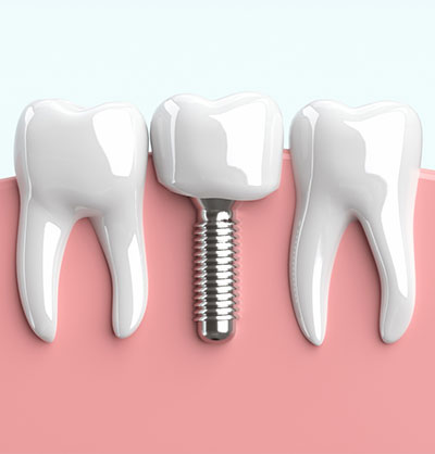 安全なインプラント手術のために