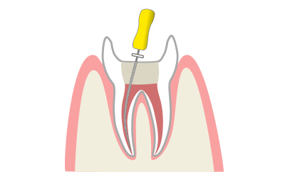 根管治療