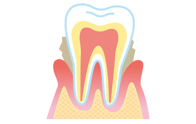 歯周病治療