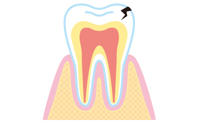 歯の亀裂の確認