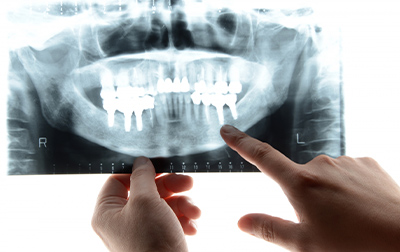 レントゲン検査