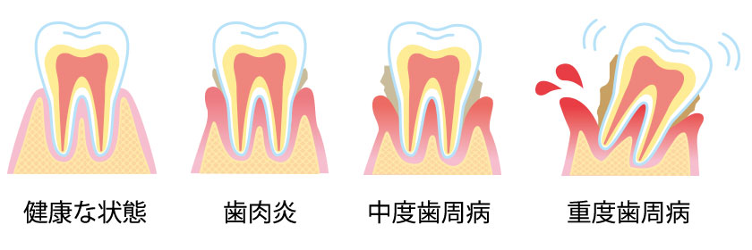 歯周病の種類画像