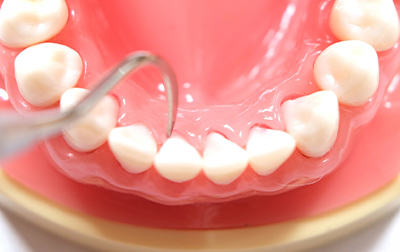 歯周ポケットそうは術